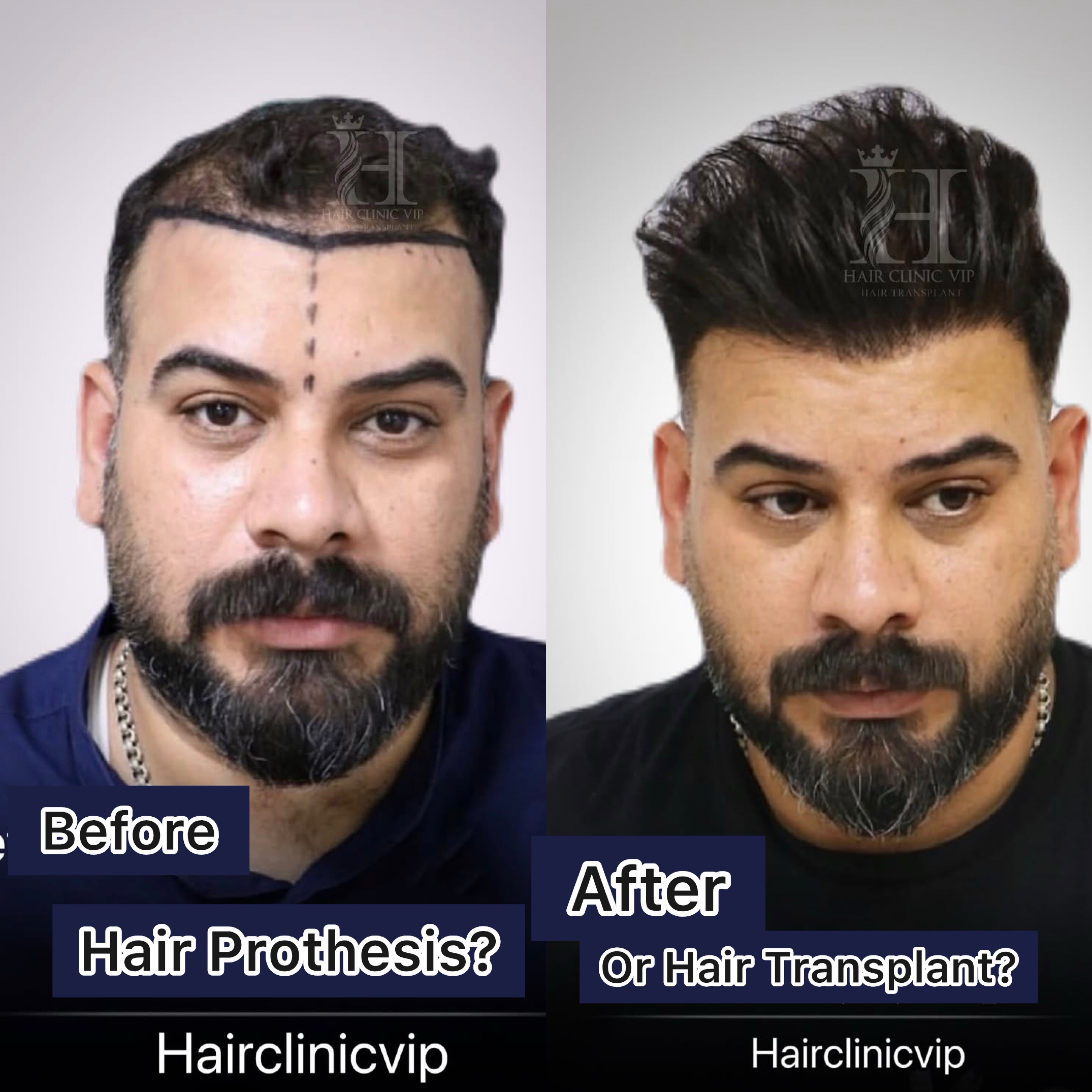 Hair System or Hair Transplant? Which Method Is Better for You at VIP Hair Transplant Clinic?