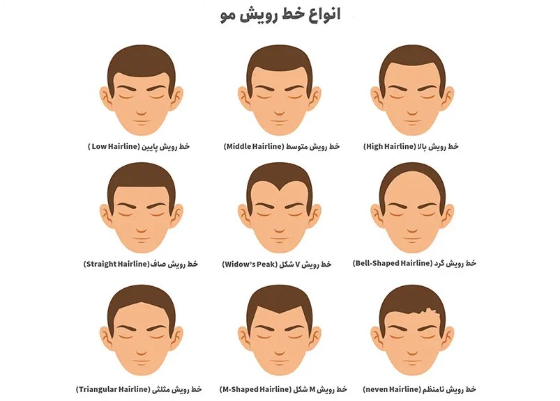 ?Hair Transplant for a Receding Hairline: How Is a Natural Hairline Designed