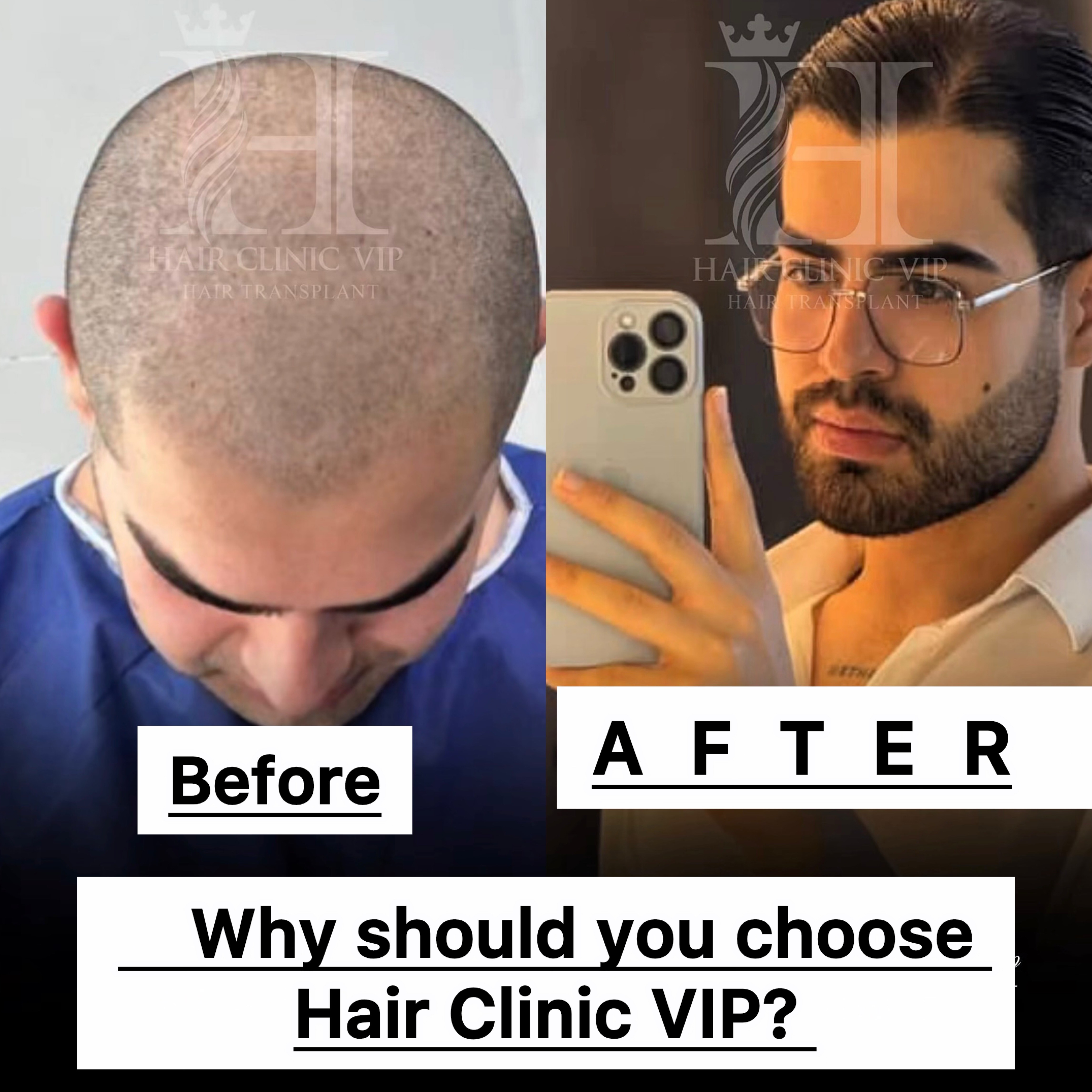 ?Why Next-Gen Hair Transplant at VIP Hair Transplant Clinic Dubai Stands Out