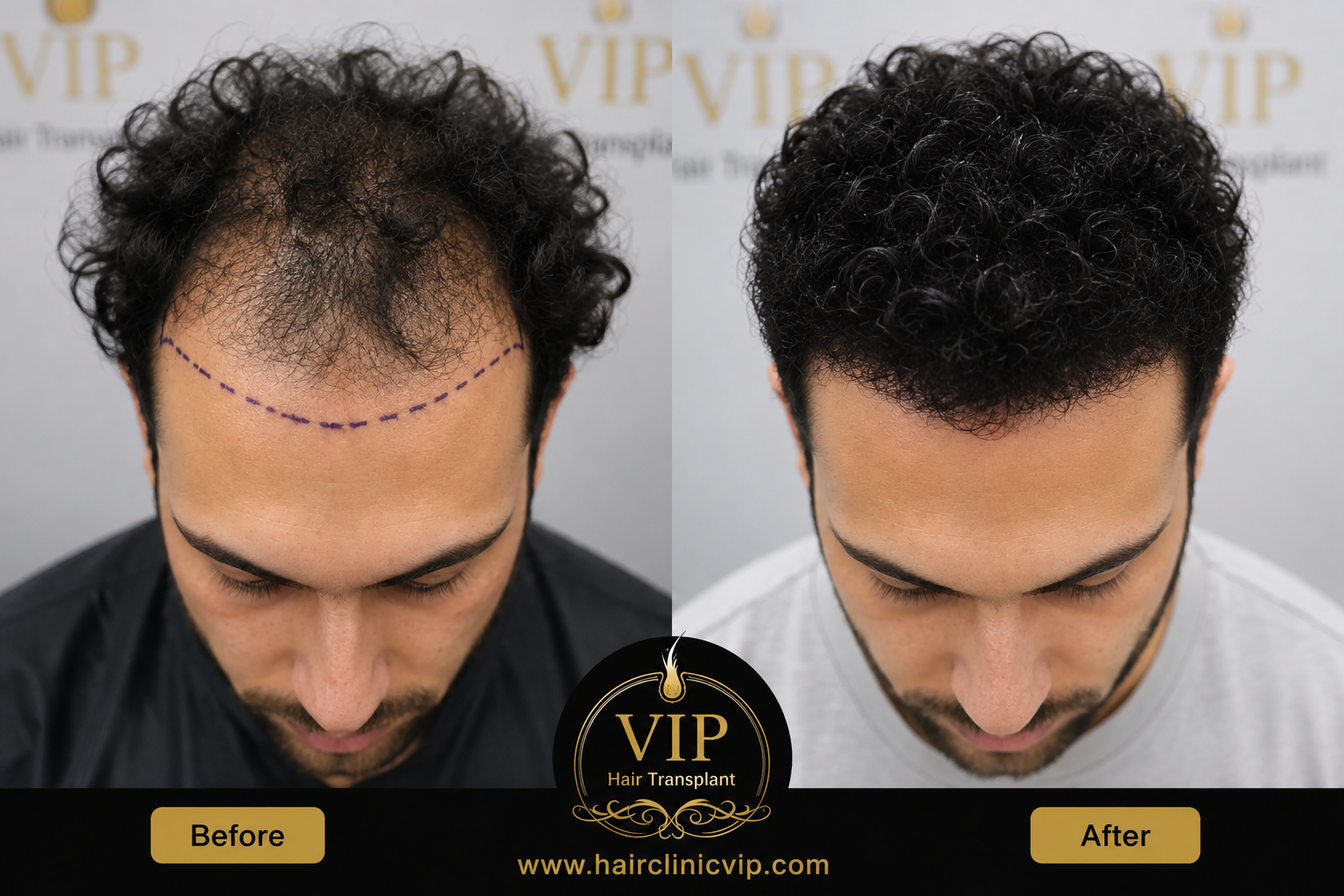 Hair Transplant for Curly and Wavy Hair: How Is It Different from Straight Hair?