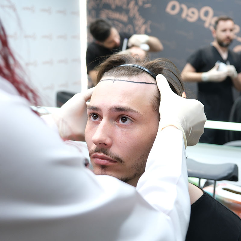 How Hair Transplant is Performed | Hair Transplant at VIP Clinic