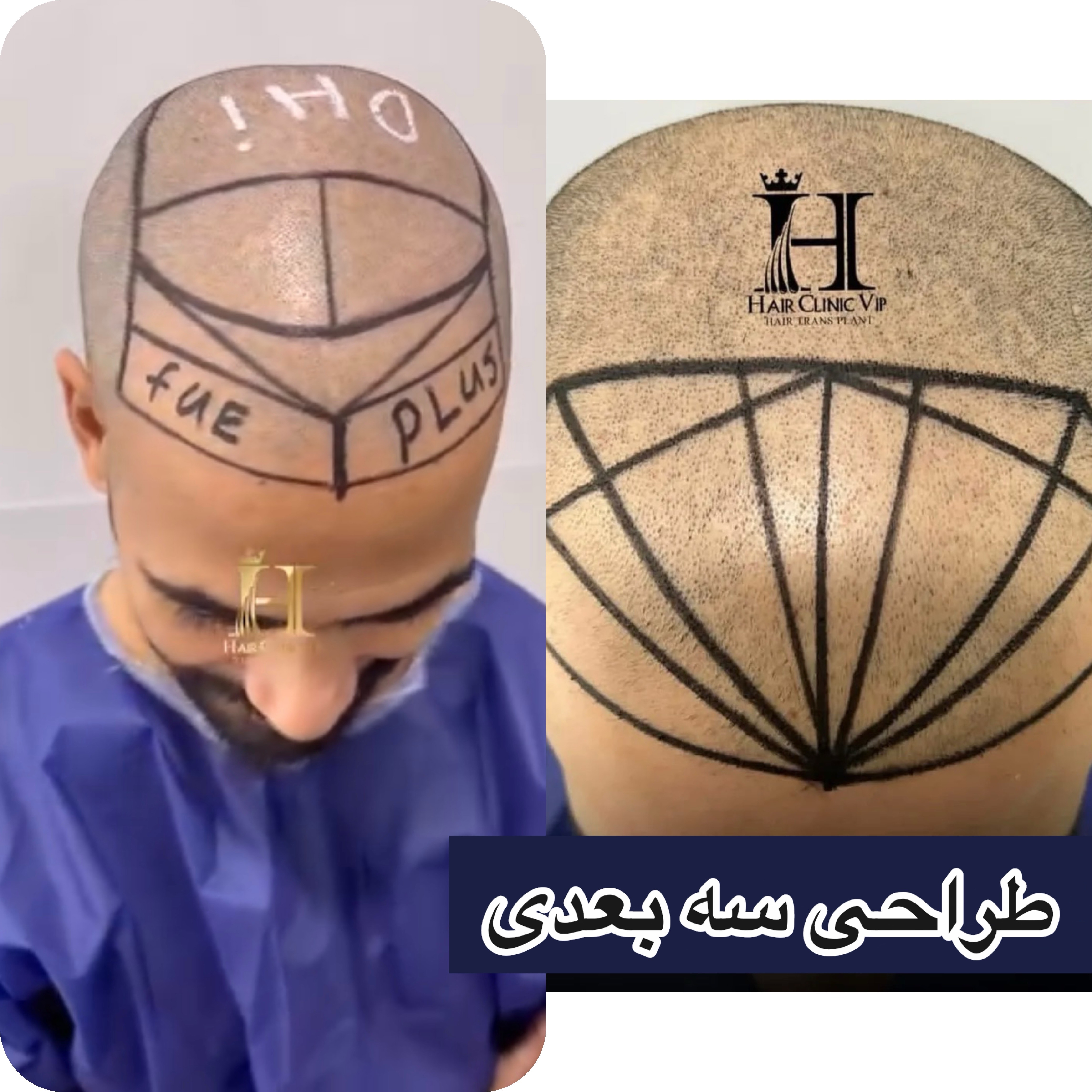 عوارض احتمالی کاشت مو به روش Super FUE Plus در کلینیک کاشت موی VIP
