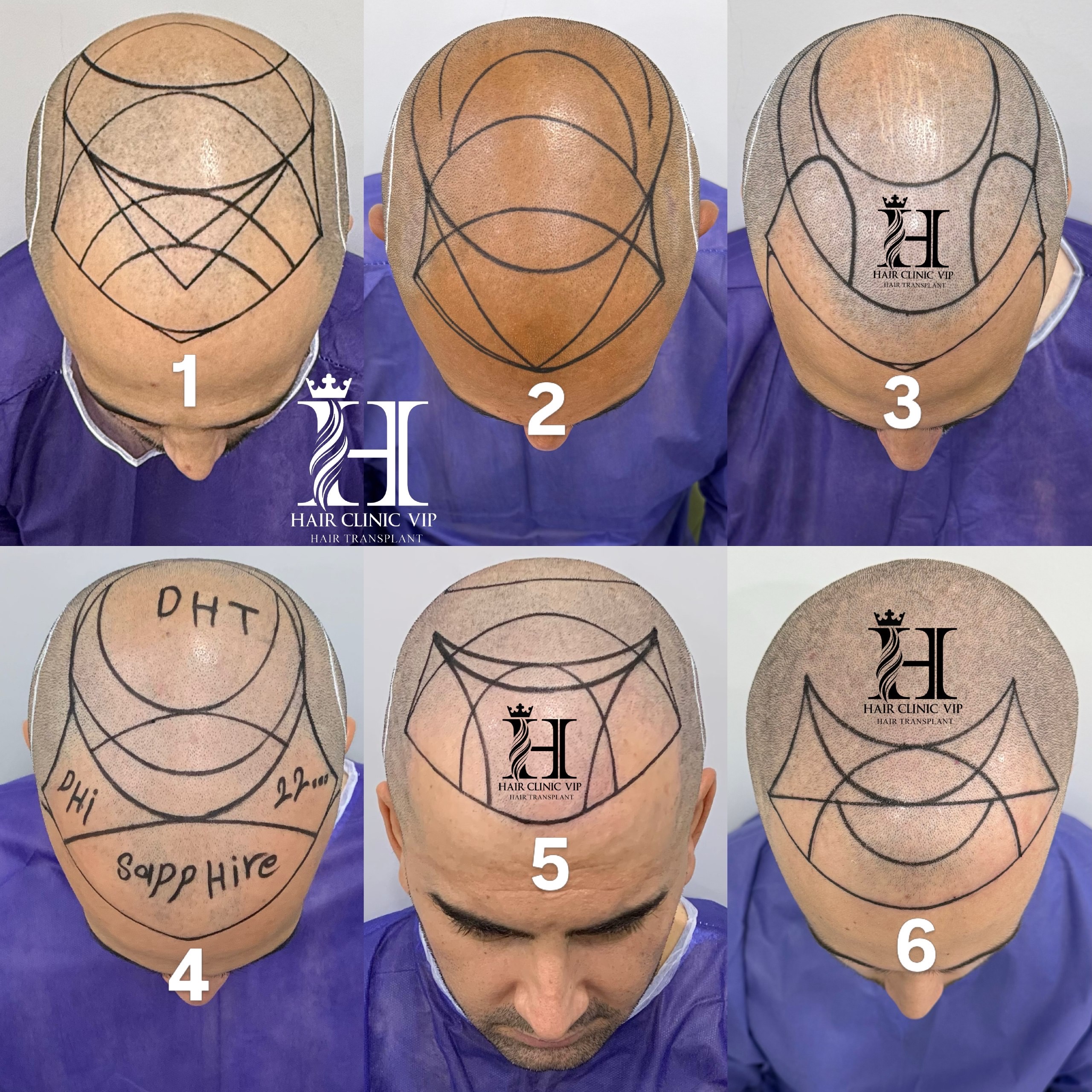 When Is It Too Late for a Hair Transplant? Limitations of Hair Transplantation in Advanced Baldness