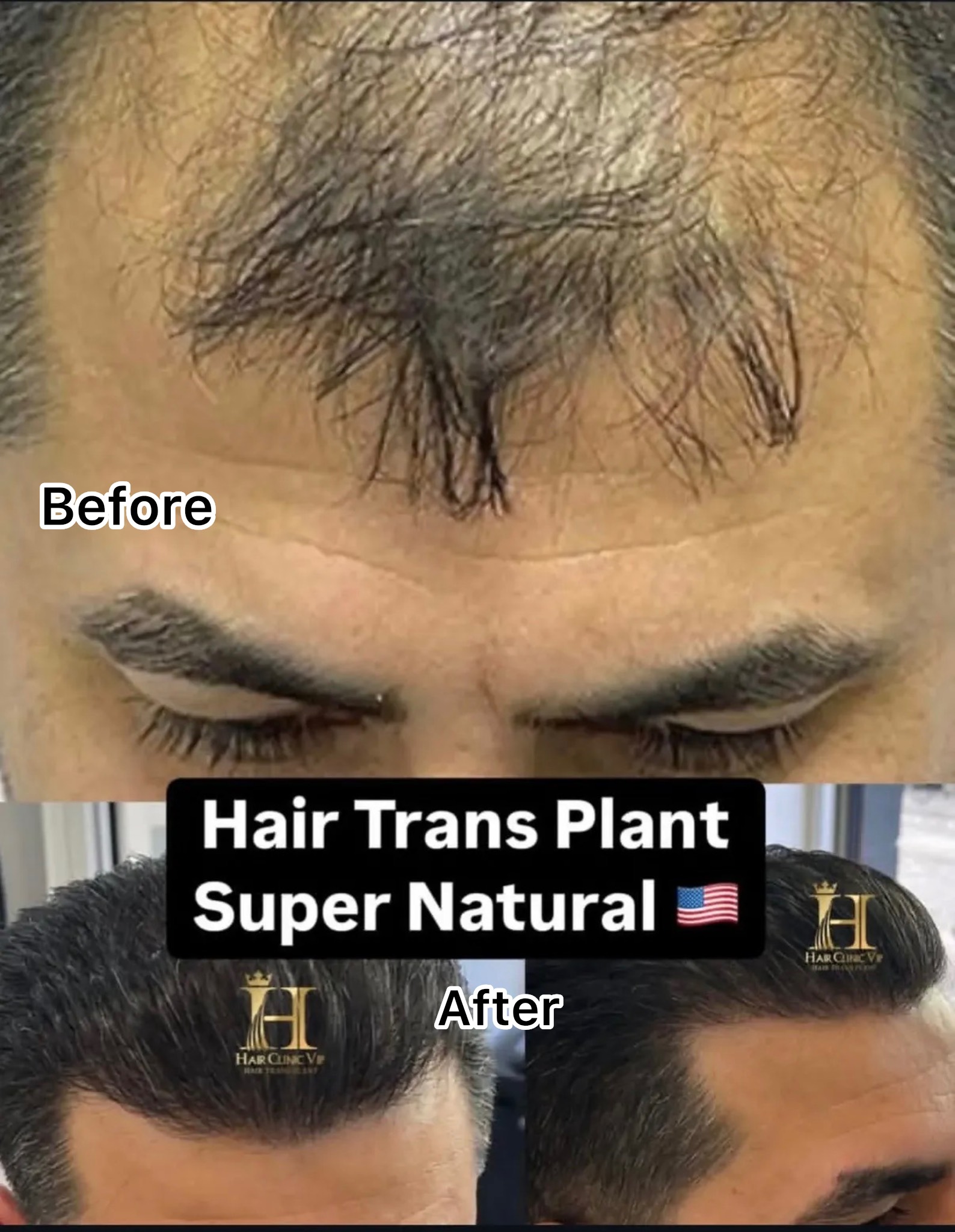 Lifetime Donor Area Management at VIP Hair Transplant Clinic in Dubai: From 25 to 65 Without Wasting a Single Graft