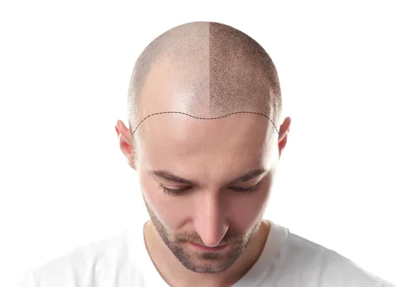 زراعة الشعر